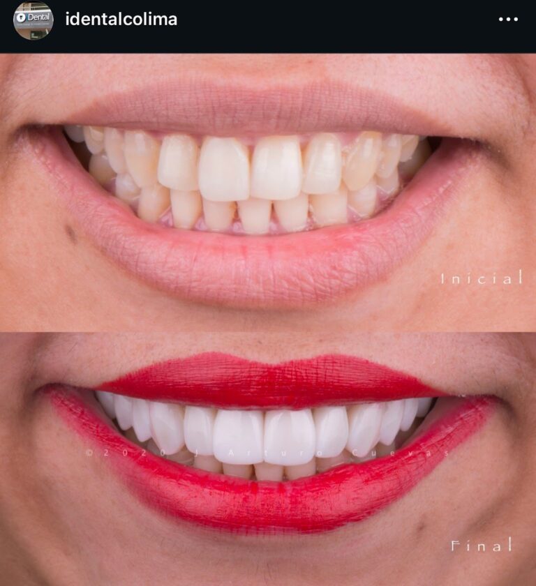 17203 dr. jorge arturo cuevas 8211 idental manzanillo 8211 diseno de sonrisa 8211 carillas dentales 8211 dentista 8211 implantes dentales 8211 768x840