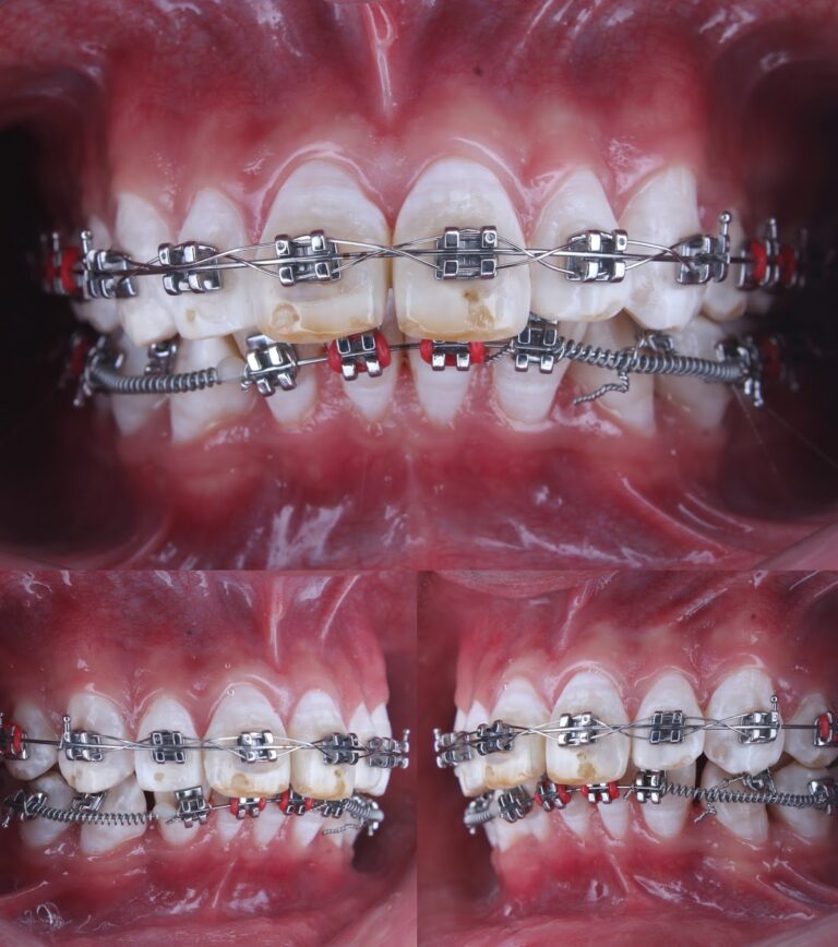 17217 vital dent durango carillas ortodoncia 768x868