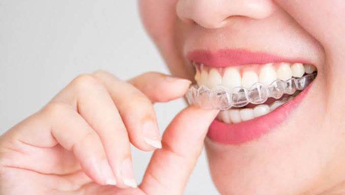 17301 clinica dental sm 8211 invisalign provider ortodoncia invisible