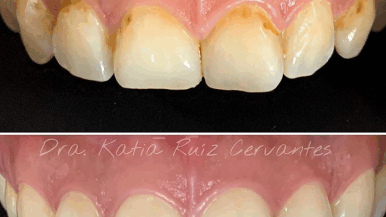 17335 implantes dentales morelia cenit odontologia avanzada dentistas en morelia diseno de sonrisa 768x432